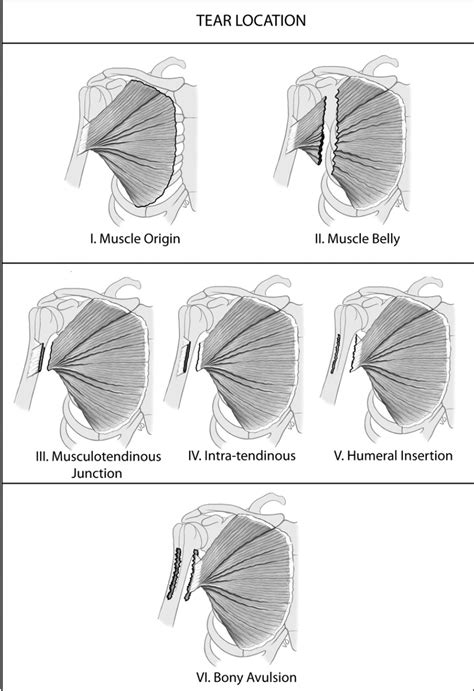 pectoralis rupture elbow